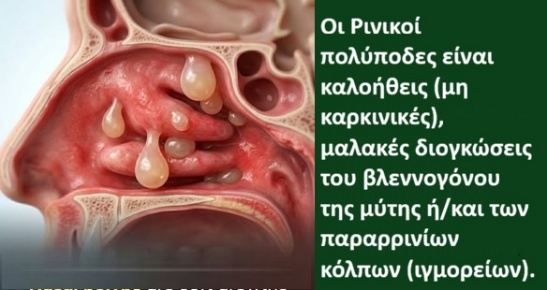 Rinikoi Polypodes Mia Synchroni Anaskopisi tou Orismou, tis Pathofysiologias kai tis Therapeftikis Antimetopisis