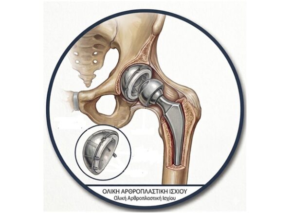 Oliki Arthroplastiki Oliki Arthroplastiki